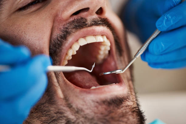 Best Emergency Wisdom Tooth Extraction in University, FL